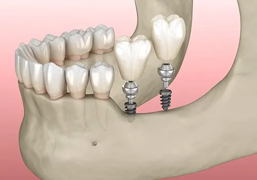 Low jaw bone image